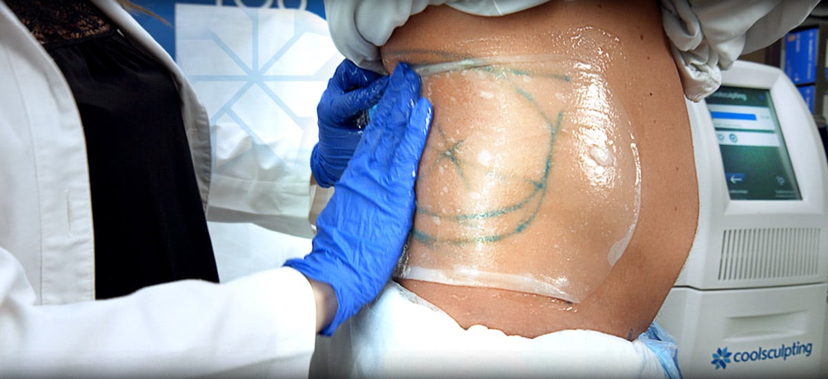 CoolSculpting Procedure by Riverchase