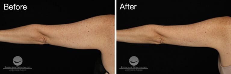 CoolSculpting Arms Results 2