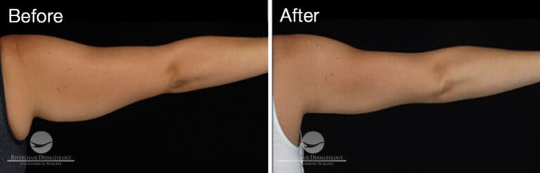 CoolSculpting Arms Results 1