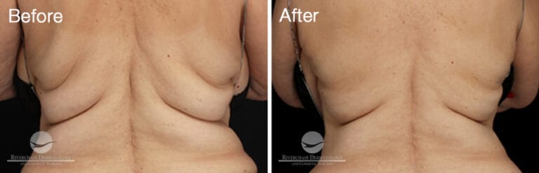 CoolSculpting Results Back