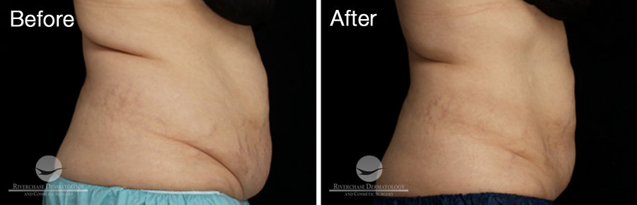 CoolSculpting Patient Results | Flanks