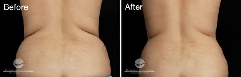 CoolSculpting Back Patient Results