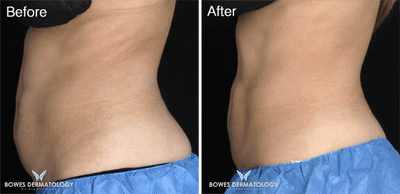 Abdomen treated with CoolsCulpting Photo 3