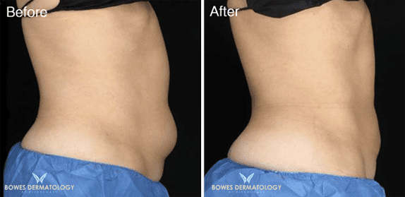 Abdomen treated with CoolsCulpting Photo 1