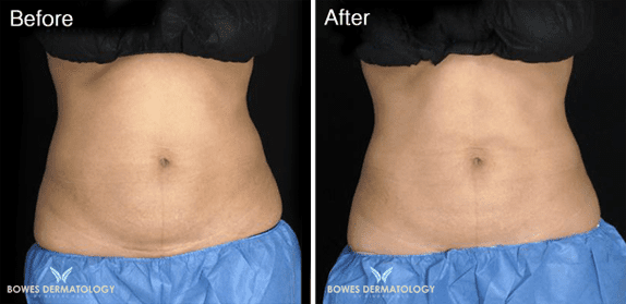 Abdomen treated with CoolsCulpting Photo 2