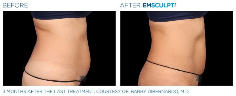 Emsculpt before and after image 1