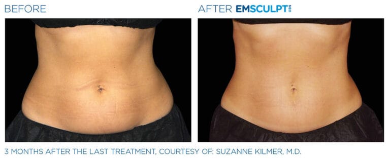 Emsculpt before and after image 2