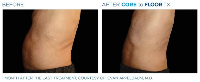 Emsculpt before and after image 3