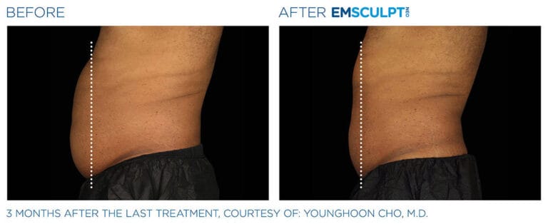 Emsculpt before and after image 4