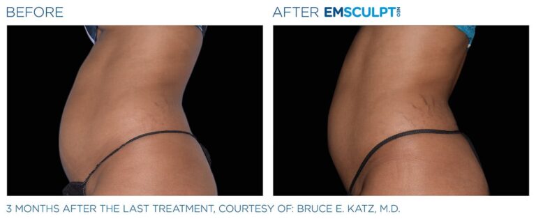 Emsculpt before and after image 5