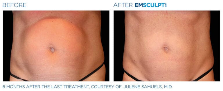 Emsculpt before and after image 6